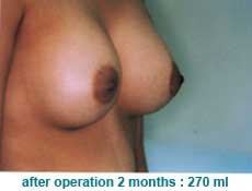 plastic-surgery-breast-augmentation 
